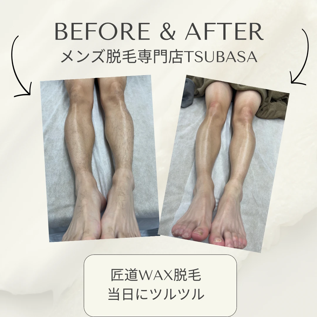 メンズ脱毛を始めるには